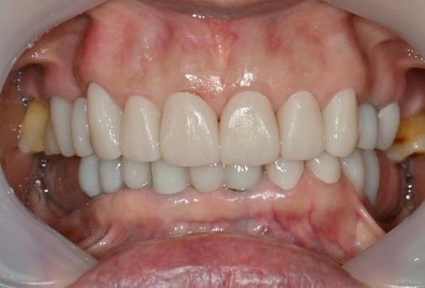 임시보철 확인 후 제작하여 구강 내에서 확인한 최종보철