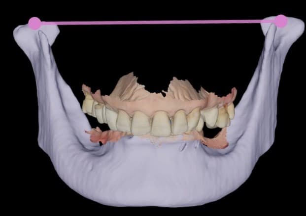 하악 3D 모델과 양쪽 과두를 잇는 기준선에 맞춰 정렬한 상·하악 구강스캔 데이터